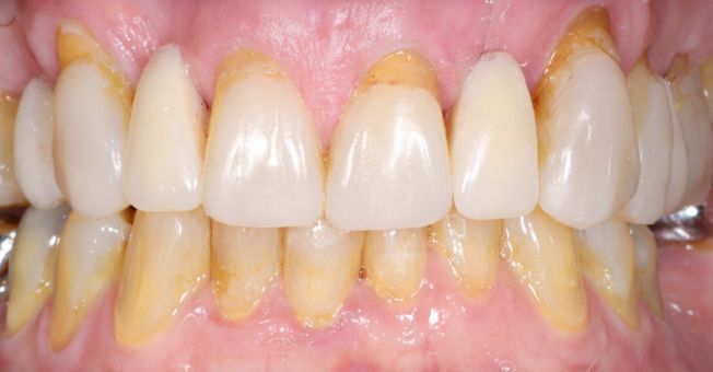 Case 7 Cosmetic bonding after