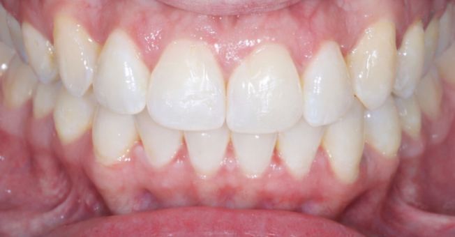 Case 3 Invisalign after