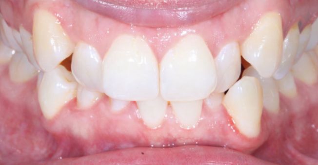 Case 3 Invisalign before