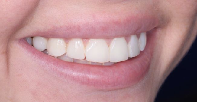 Case 1 Teeth Whitening after