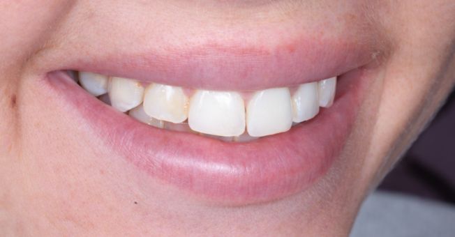 Case 1 Teeth Whitening before