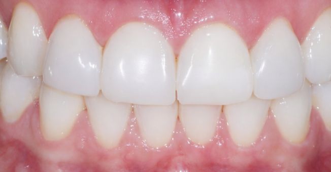 Case 4 Cosmetic Bonding after