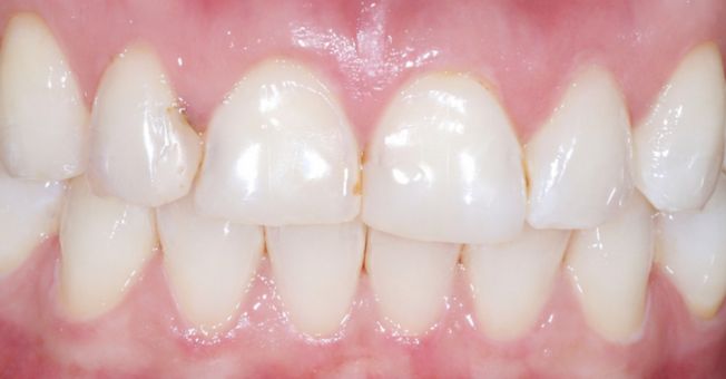 Case 4 Cosmetic Bonding before