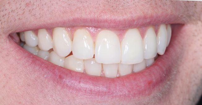 Case 2 Teeth Whitening after