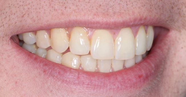 Case 2 Teeth Whitening before