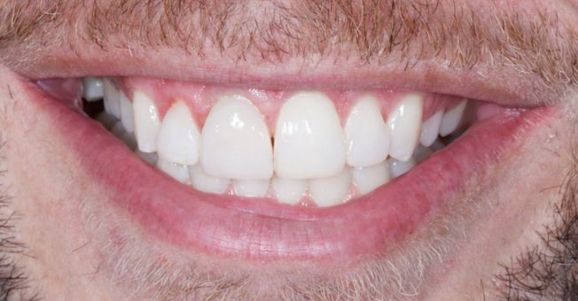 Case 5 Cosmetic Bonding after