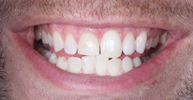 Case 5 Cosmetic Bonding before
