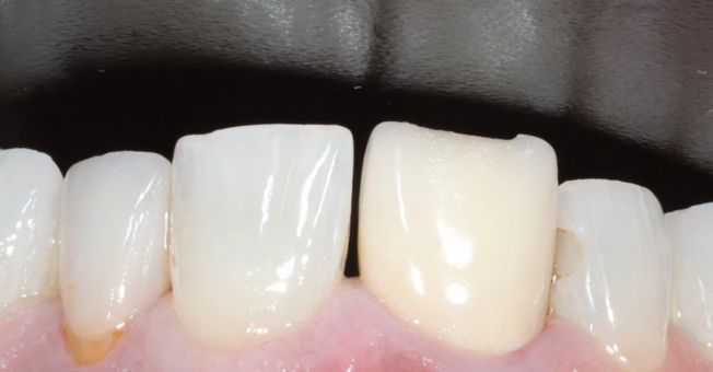 Crowns + teeth whitening before