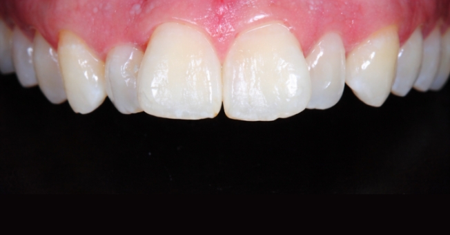 Case 4 Invisalign before
