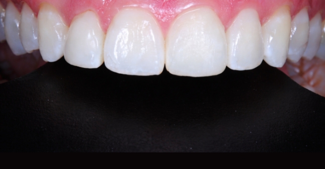 Case 4 Invisalign after