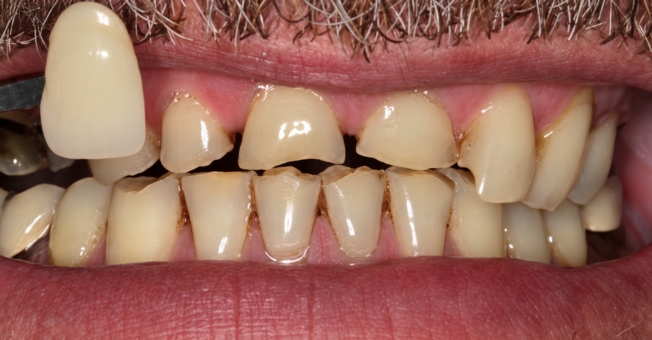 Case 1 Porcelain Veneers before