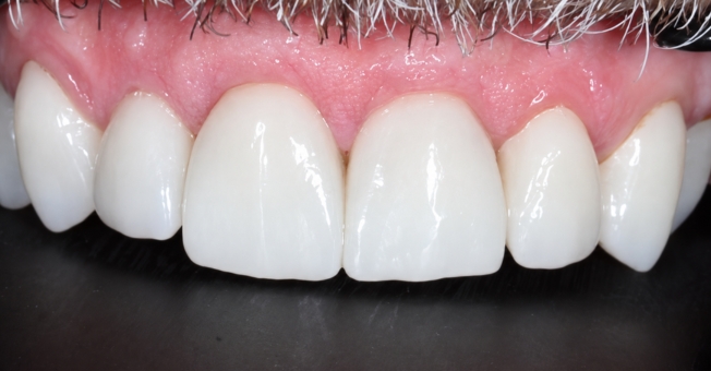 Case 1 Porcelain Veneers after