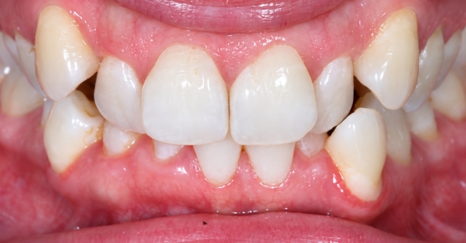 Case 5 Invisalign® before
