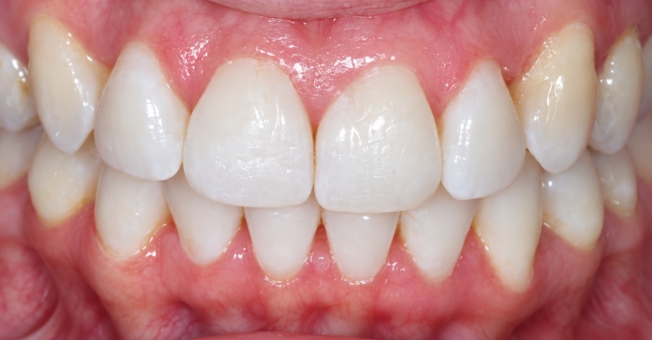 Case 5 Invisalign® after