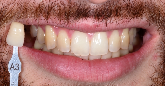 Case 3 Teeth Whitening before