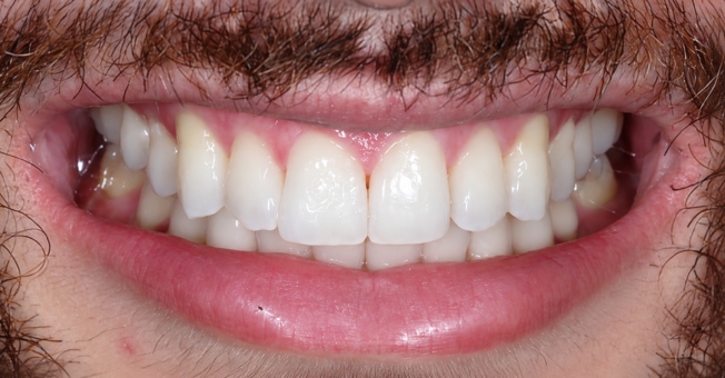Case 3 Teeth Whitening after